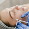 PRP Treatment