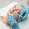 PRP facial