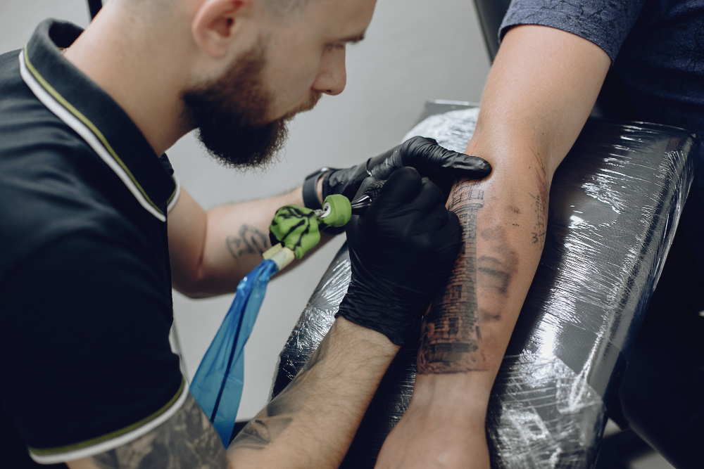 laser tattoo removal 